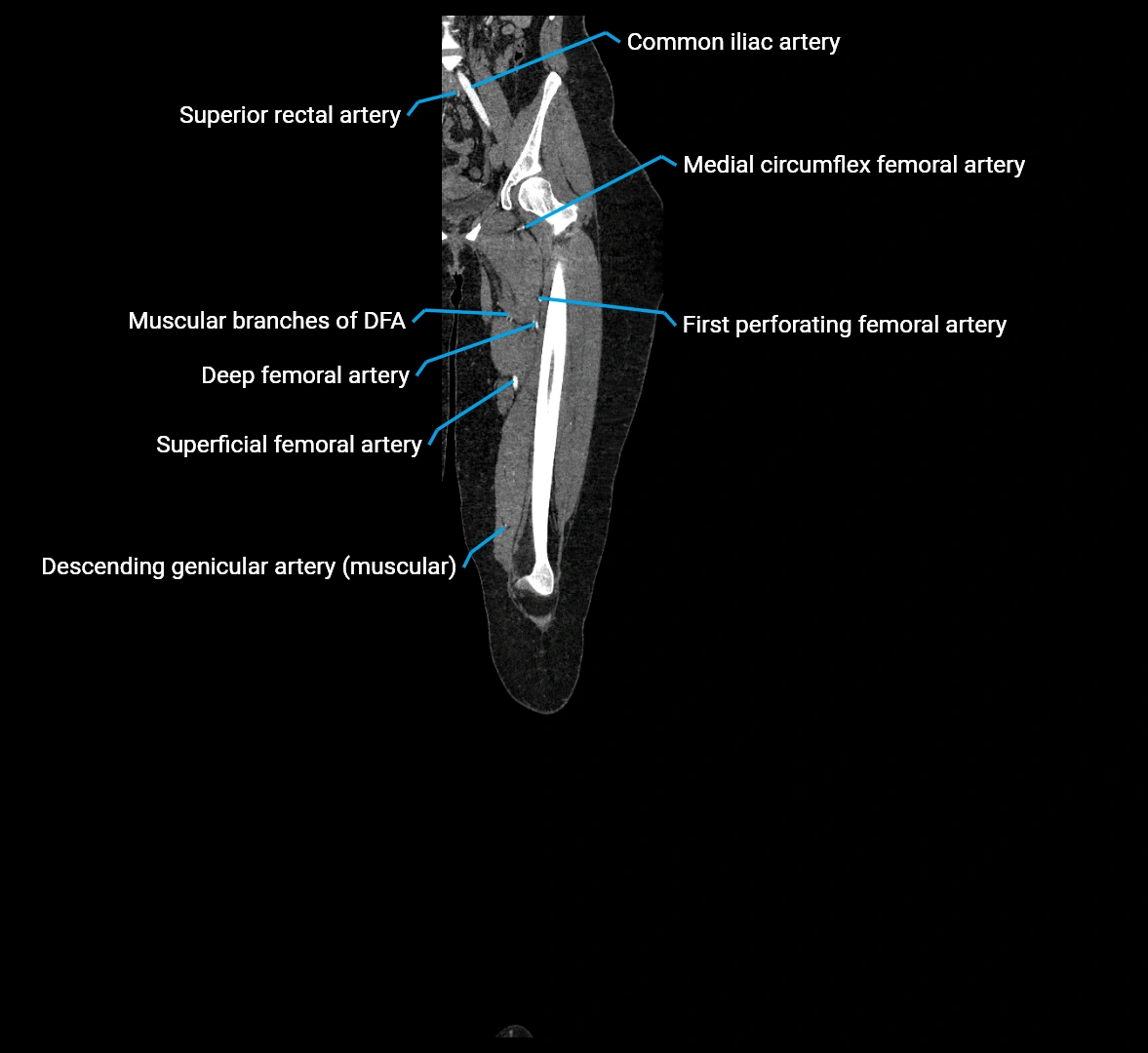 CTA lower limb coronal cross sectional anatomy labelled image _31 (2).webp